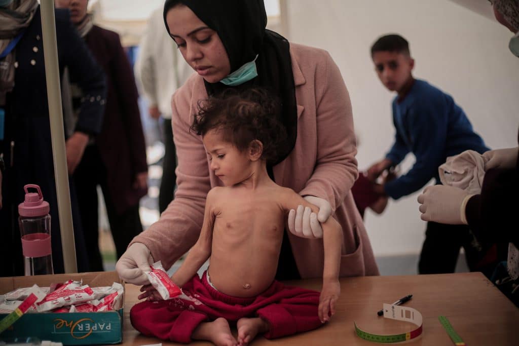 Leen, 2 ans, souffre de malnutrition aiguë sévère. Elle souffre d'une perte de poids et d'une atrophie musculaire drastiques. © UNICEF/UNI519948/El Baba