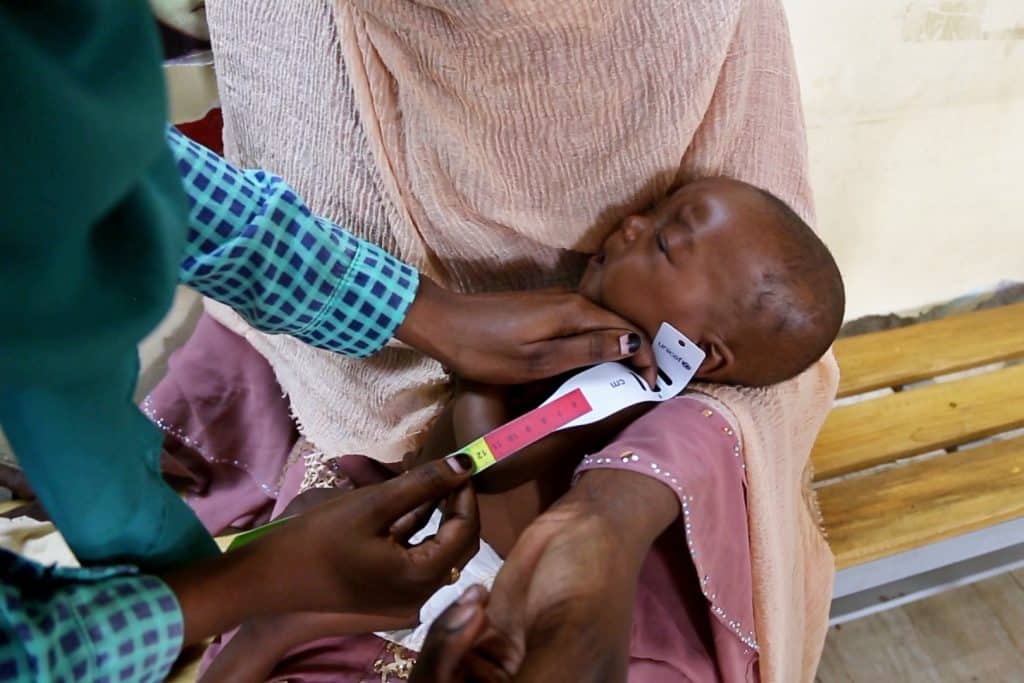 Un agent de santé de l'hôpital de Damazine, dans l'État du Nil Bleu au Soudan, examine Baraa, âgée de 6 mois et souffrant de malnutrition.© UNICEF/UNI593591/