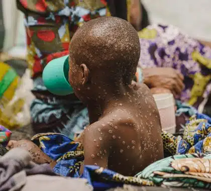 Mpox : Au Burundi, un tiers des cas sont des enfants en âge d’aller à l’école