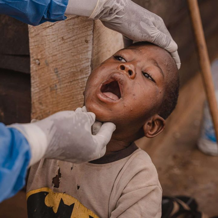 mpox rdc enfant vaccination