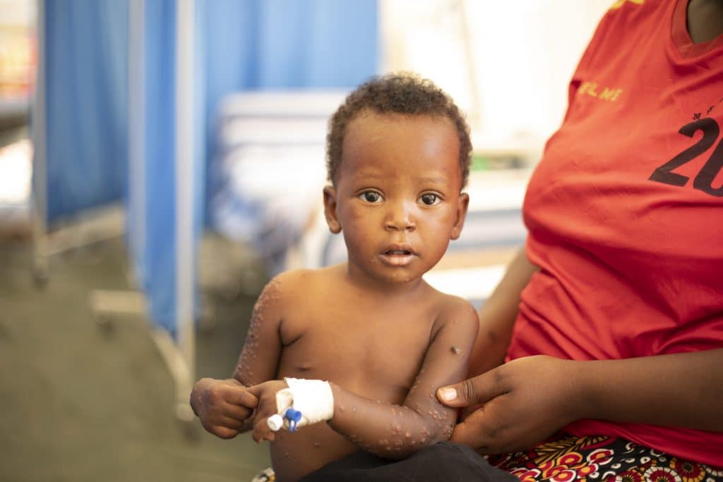 Amie-Grâce, 1 an et demie, est atteinte de la Mpox. Elle suit un traitement au sein de la Clinique Prince Louis au Burundi soutenue par l'UNICEF. © UNICEF/UNI649396/Muco